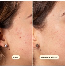 FRESHLY SERUM TRATAMIENTO ACIDO ACELAICO ACNE Y ROSACEA 50ML